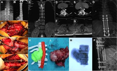 One-stage En bloc resection of thoracic spinal chondrosarcoma with huge paravertebral mass through the single posterior approach by dissociate longissimus thoracis
